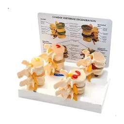 A-ONE SCIENCE Multicolor PVC Lumbar Vertebrae Degeneration Model AOSBM38-image-35