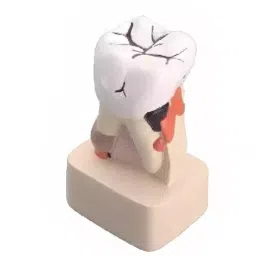 A-ONE SCIENCE Multicolor PVC Diseased Tooth Model AOSBM151-image-68
