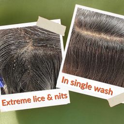 generic Natural Tea Tree Anti Lice & Nits Shampoo | Removes Stubborn Lice, Nits & Lice Eggs | Tea Tree & Neem Formulation | Right From Age 3 to Adults | 100ml image 4