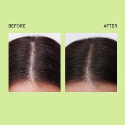 Quench Dandruff Control Scalp Scrub With Tea Tree Extracts | Eliminates Dandruff, Flakes & Itchiness | Clears Scalp Of Dead Skin & Oil Buildup | Made In Korea (200Ml) image 5