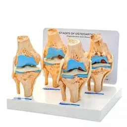 BTC INSTRUMENTS Life Size Ivory PVC Knee Arthritis Model with Ligaments for Medical Labs, BTC-RX-110-14