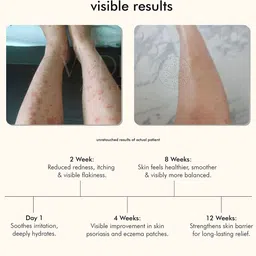 VEDICDERM Set Of 2 Psoriasis Body Cream With 2% Bakuchi Extract- 200 ml Each image 4