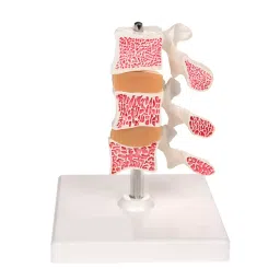 A-ONE SCIENCE Multicolor PVC Vertebral Osteosis Model AOSBM34-image-71