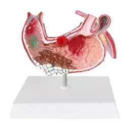 A-ONE SCIENCE Multicolor PVC Diseased Stomach Model AOSBM140-image-65