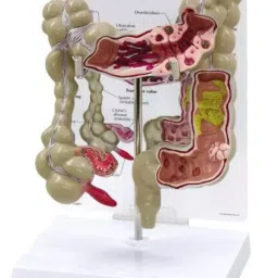 A-ONE SCIENCE Multicolor PVC Colon Pathalogical Model AOSBM168-picture-41