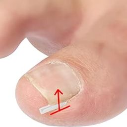 BNF Ingrown Toenail Corrector Strips Curved Toenail Corrector Foot Care-10