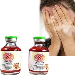 Aloe Vera Extract Vitiligo Cream Gel, Remove Vitiligo On Lips, Ringworm White Spot, White Patches, Even Skin Tone, Vitiligo Cream CREAM.-image-1