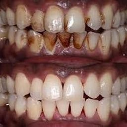 Nanni - Herbal Teeth Stain Remover | Tobacco Stain Remover | Freshens Laugh by Herbal-15