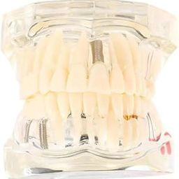 iDENTical Dental All-in-One Study Model | Includes Dental Implants, Crown & Bridge, Root Canal | Implant-Supported Bridge | Tooth Avulsion | Abfraction, Caries & Periapical Study Feature-25