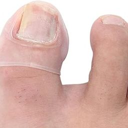 LYLA Toe Nail Ingrown Correction Foot Care Paronychia Silicone Corrector Sleeves-image-43