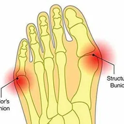 erinshop Toe Separators Ring for Overlapping Big Toes, Bunions, Alignment, Spacers image 4