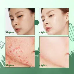 winry Green Tea Sticks Face Shaping Mask (Pack of 1) Face ShapingFace Shaping Mask image 5