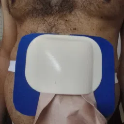 STOMA GUARD FOR COLOSTOMY Bandage Protector-image-38
