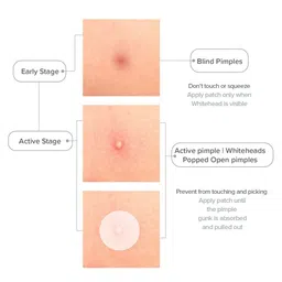 PRIVEDA Acne Pimple Patch - 57 Patches image 5