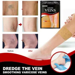 Veins Patches Dredge Vein Smoothing Varicose Veins Heel Support-picture-23