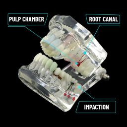 iDENTical Dental All-in-One Study Model | Includes Dental Implants, Crown & Bridge, Root Canal | Implant-Supported Bridge | Tooth Avulsion | Abfraction, Caries & Periapical Study Feature image 5
