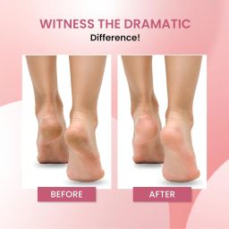 Urban Yog Callus Remover with 3 Interchangeable Head Rollers, Rechargeable, Callus & Dead Skin Removal, 2 Speed Settings, Fast Type-C Charging, 1200mAh Battery image 1