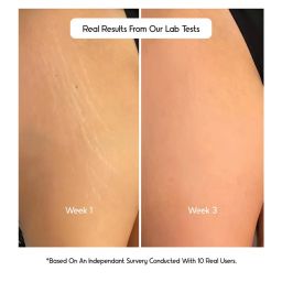 Cos-IQ Stretch Mark Removal Roll-On Serum 80ml | with Striover | Scar Removal | Uneven Skin Tone | All Skin Types | 60 Days Pack image 4
