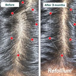 refollium Hair Vitamins with DHT Blockers & Biotin for Hair Regrowth & Hairfall Control image 5